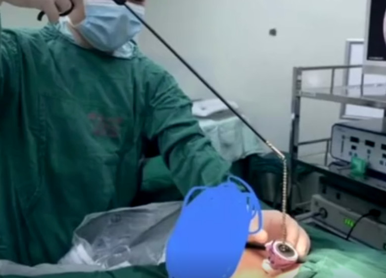 男孩把70颗磁力珠塞进尿道!家长们别再买了