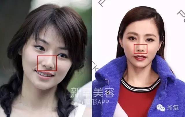 16萬的瘦臉、24萬的雙眼皮，天價(jià)整形背后的秘密！