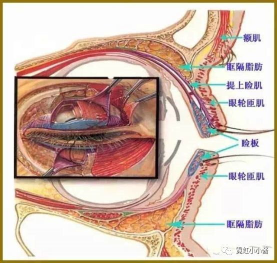 要宽变窄,就要把皮肤和眼睑板重新分开.这就叫 剥离粘粘.