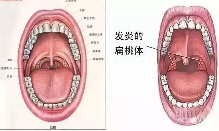 过度肥大的腭扁桃体还可能引起睡眠呼吸障碍,吞咽及语言障碍.