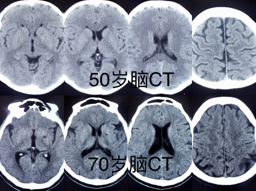 50岁记忆力减退医生说得了脑萎缩,专家对比完脑ct片子