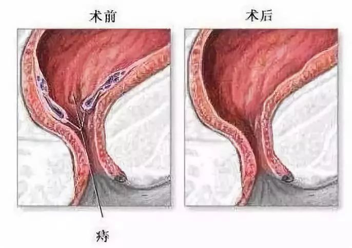 痔疮术后水肿怎么办?