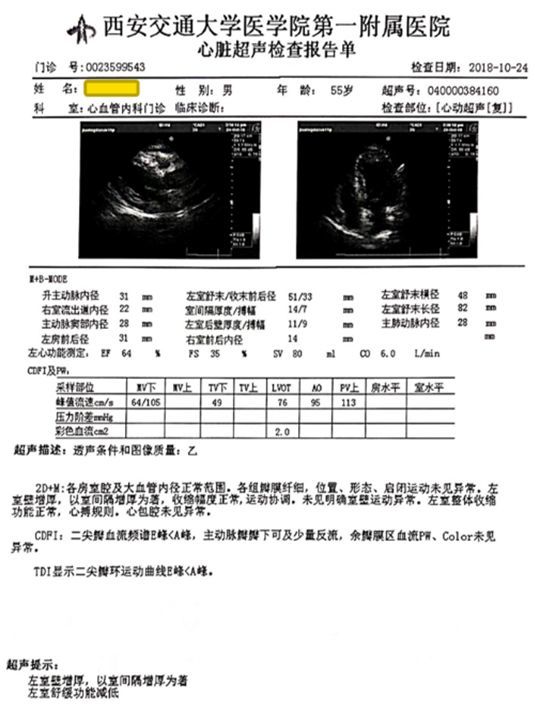 超声心动图示心脏射血分数(ef值):64%,左室舒张末内径:51mm,左室收缩