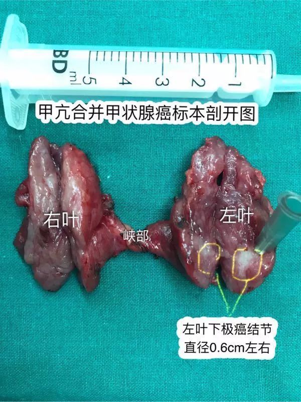 甲状腺癌处于亚临床阶段,癌结节比较小,肿瘤位于甲状腺腺体内,肿瘤