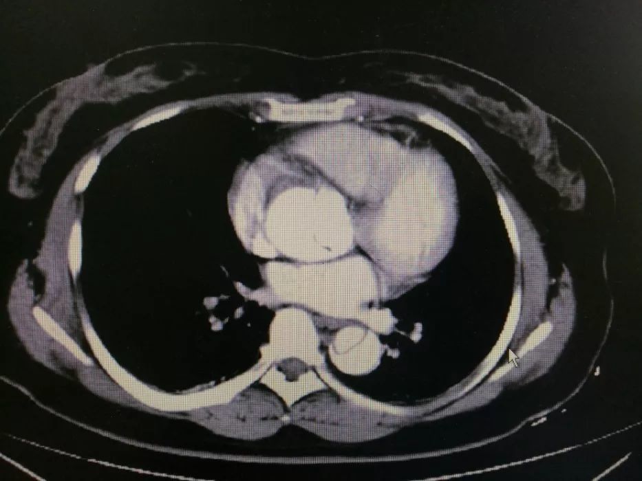 突发腹痛4小时,这种病如果误诊漏诊,后果…