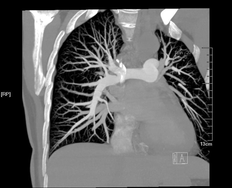 做个肺动脉cta(肺血管双源ct)!