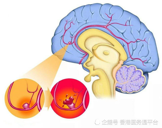 脑动脉瘤是怎么形成?香港医务通和你讲述