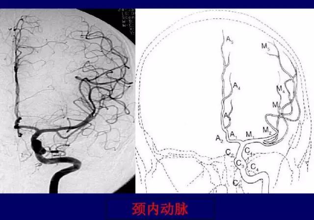 十分钟,教你轻松看懂脑血管造影