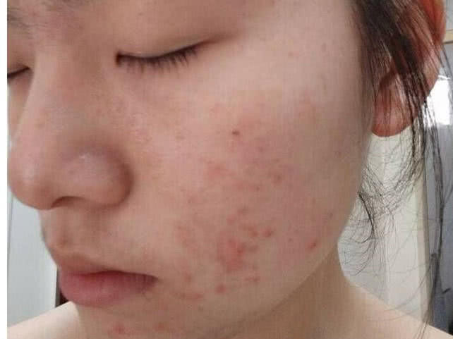 青春期"痘痘"旺盛?多吃3种食物,保证你脸蛋越来越嫩!
