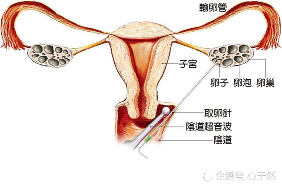 一年前为了买苹果手机,而选择卖卵的17岁女生,结果怎么样了?