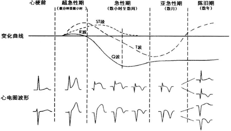 特殊类型acs (1)wellens综合征 wellens综合征的心电图多为胸痛后记