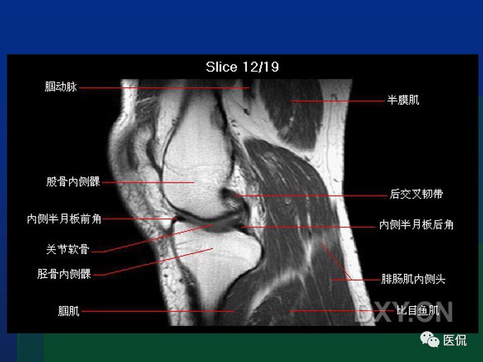 膝关节mri解剖及损伤#医学影像经典ppt