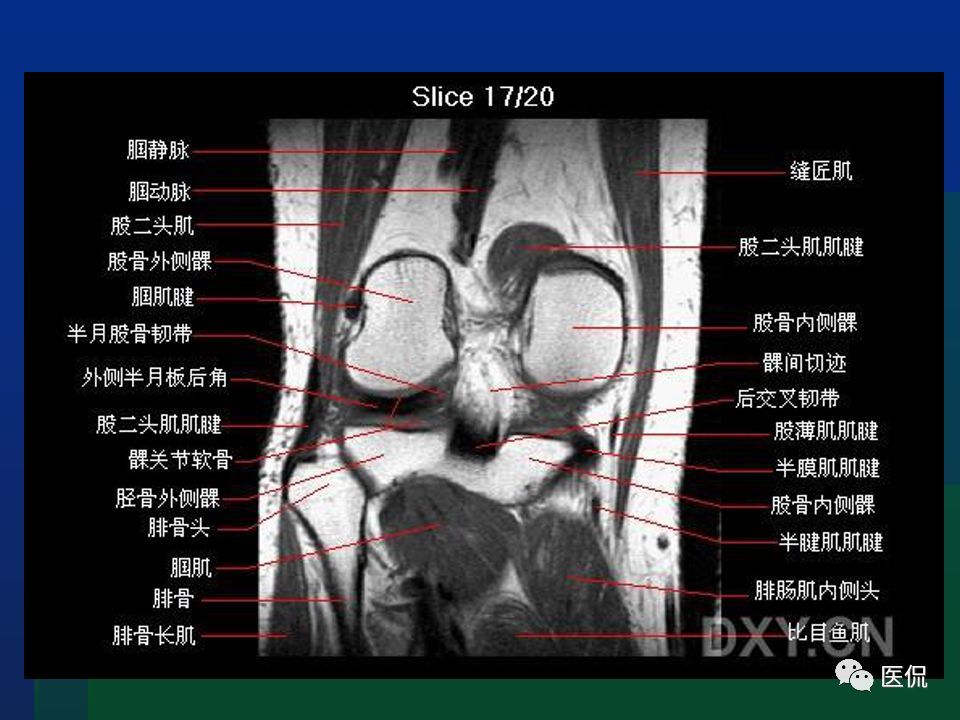 膝关节mri解剖及损伤#医学影像经典ppt
