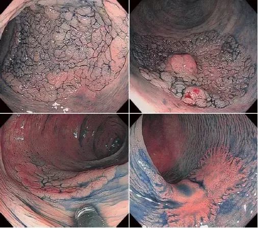 规范肠镜检查,提高早期肠癌的检出率