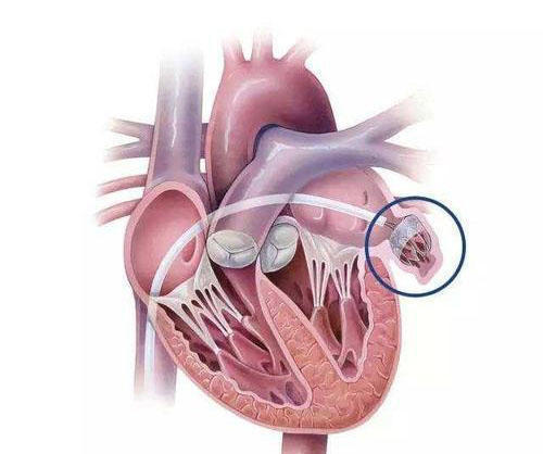 腾讯新闻-share555大夫明白话这些心脏手术：心脏支架！搭桥！移植！起搏！射频！(7)