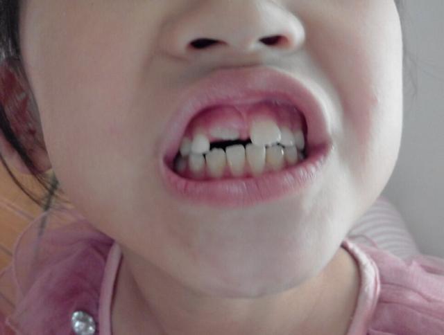 7岁孩子牙缝宽的能塞硬币!妈妈们请放宽心,看看牙医怎么说