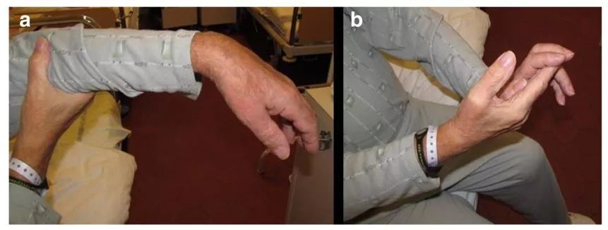左侧垂腕,手指不能抓牢(图1),拇指和食指不能成环,提示桡神经损伤