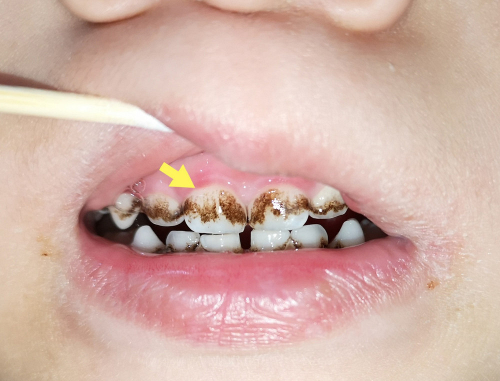 一组图告诉你,孩子的牙齿是怎么一步步被"虫子"吃掉的