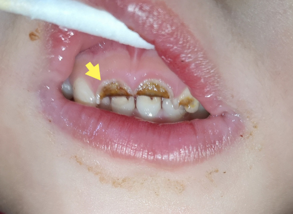一组图告诉你,孩子的牙齿是怎么一步步被"虫子"吃掉的