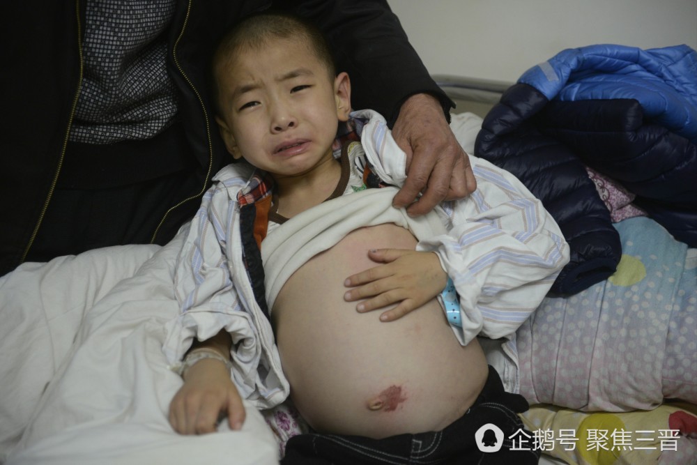 山西6岁男童患重症成"大肚娃娃" 渴盼救助