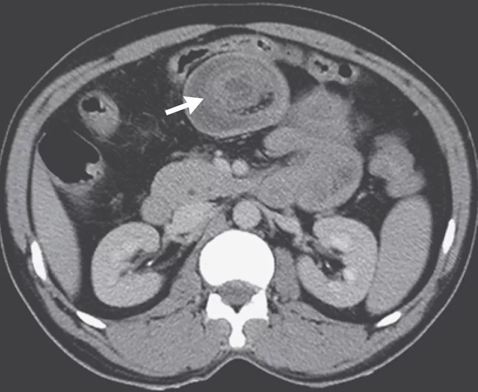 肠套叠典型ct表现-靶征(箭头所指)   图片来源:nejm