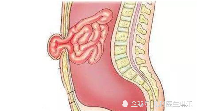 宝宝出现肚脐疝真的很可怕吗?