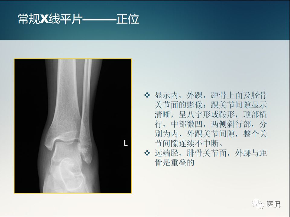 踝关节正常解剖及损伤性病变的影像表现#医学影像经典