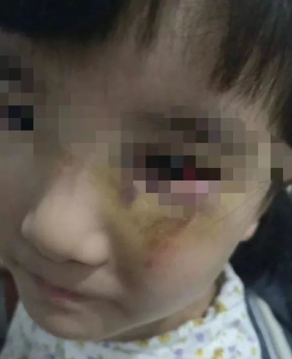 眼球出血,脸部淤青!南昌一小学老师打学生引发关注!教