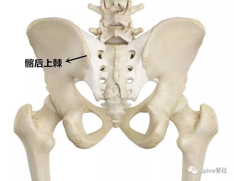 在臀上皮神经经过髂骨嵴处有明显压痛点(trigger point),并向臀部