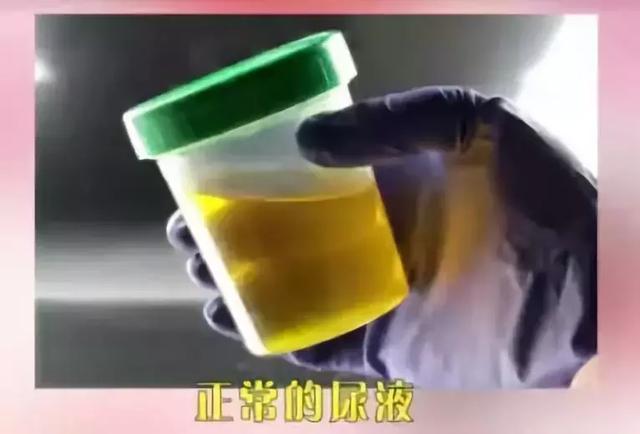 正常的尿液颜色应该是淡黄色的透明液体,如下图所示.
