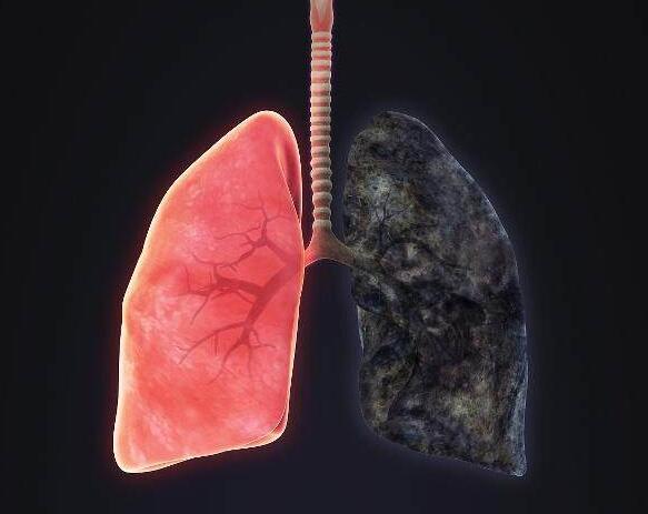 时间长了,就会出现肺泡越来越厚,肺部也呈现出黑色,尤其长期抽烟和