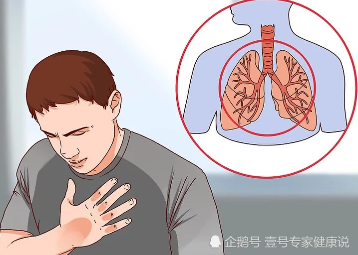 肺癌早期有3个明显症状,但出现另外3个,可能已是晚期!