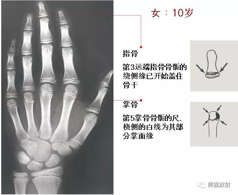 2019骨龄图谱(收藏随时对照查看)