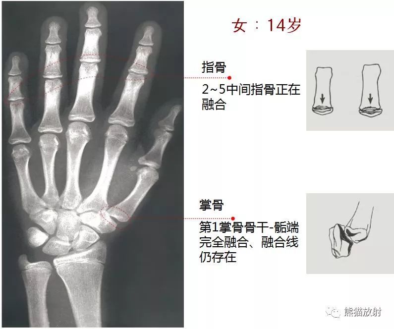 骨龄评估的临床意义:有助于儿童生长发育的监护;有助于诊断某些疾病