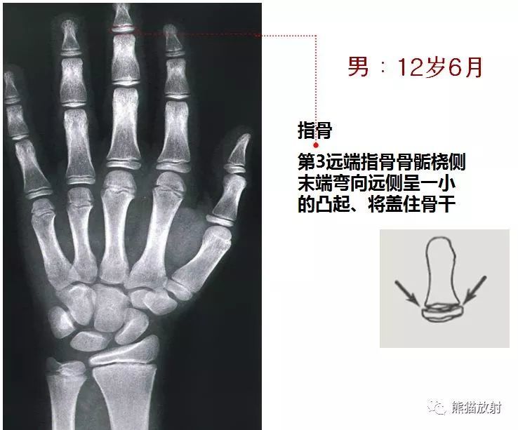 2019骨龄图谱(收藏随时对照查看)