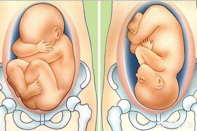 胎心在孕妇肚脐上下方,多数是胎位不正,胎位正,胎心在