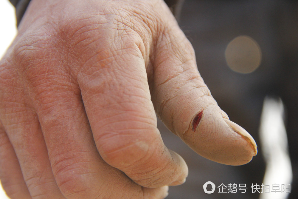 工地上,一位农民工的手指上被划破的伤痕.
