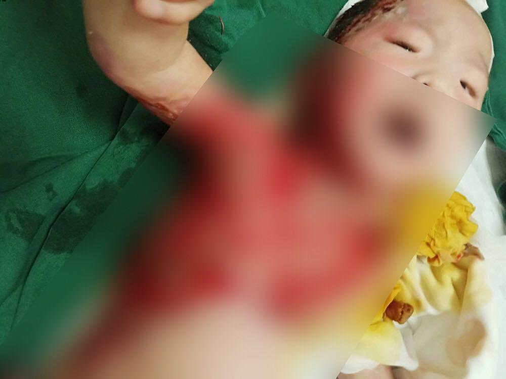 一岁婴儿全身烫伤母亲自责轻生,却被儿子的一个小动作