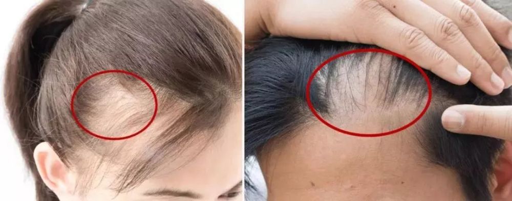 现在很多女生掉发严重,从远处看头顶就像秃顶了,而发根蓬松后,发量就
