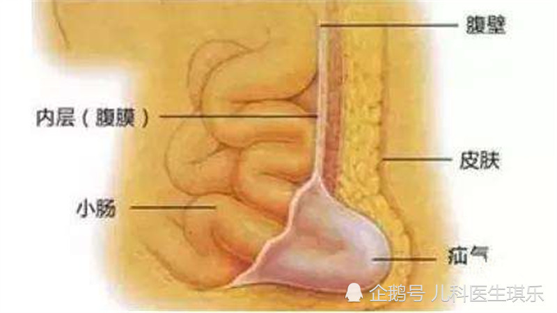 疝气,早产儿,宝宝,腹股沟疝,腹部