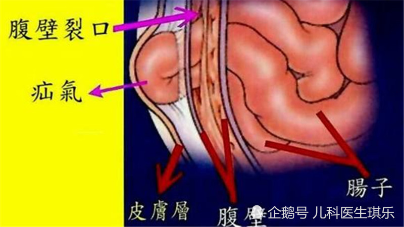 疝气,早产儿,宝宝,腹股沟疝,腹部