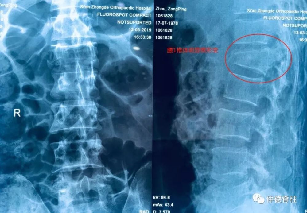 腰1椎体爆裂性骨折伴椎管狭窄症