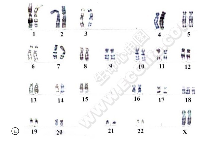 人类23条染色体的故事——第18号染色体转基因人含金的沙子