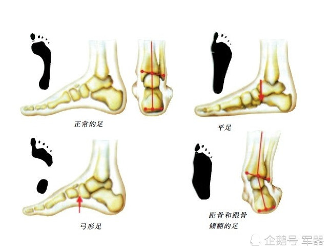 新兵体检这项过不了,就要被淘汰,扁平足为啥不能当兵?