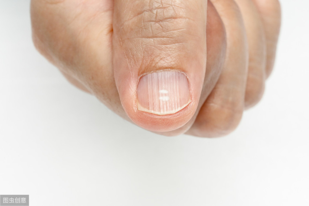 从中医来看,指甲上有纹路是不健康的,如果有横纹,多是脾胃的健康问题