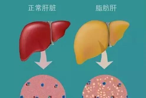 容易患上脂肪肝?常吃这些东西,对肝脏有益,消除脂肪肝