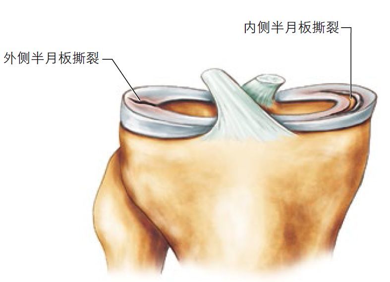 膝关节损伤,半月板