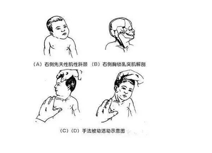 "歪脖子"大小脸,讲讲先天性斜颈宝宝康复的那些事