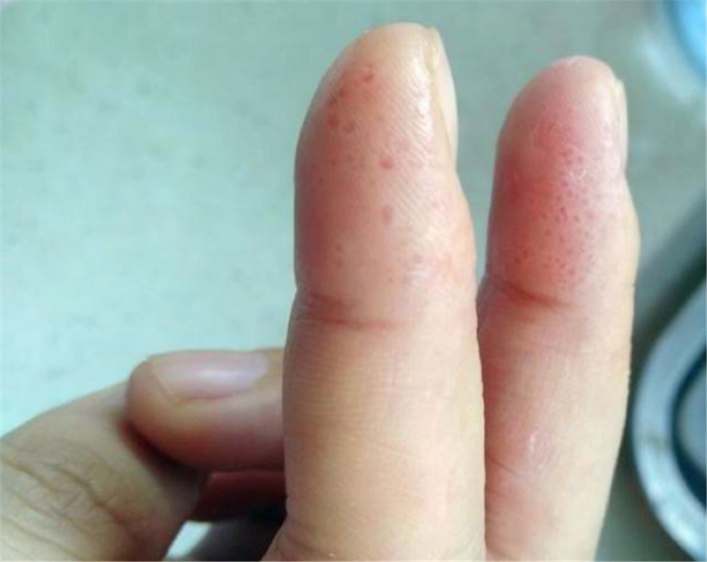 手指上长透明小水泡,有时会痒,弄破后有液体溢出,该怎么治疗?