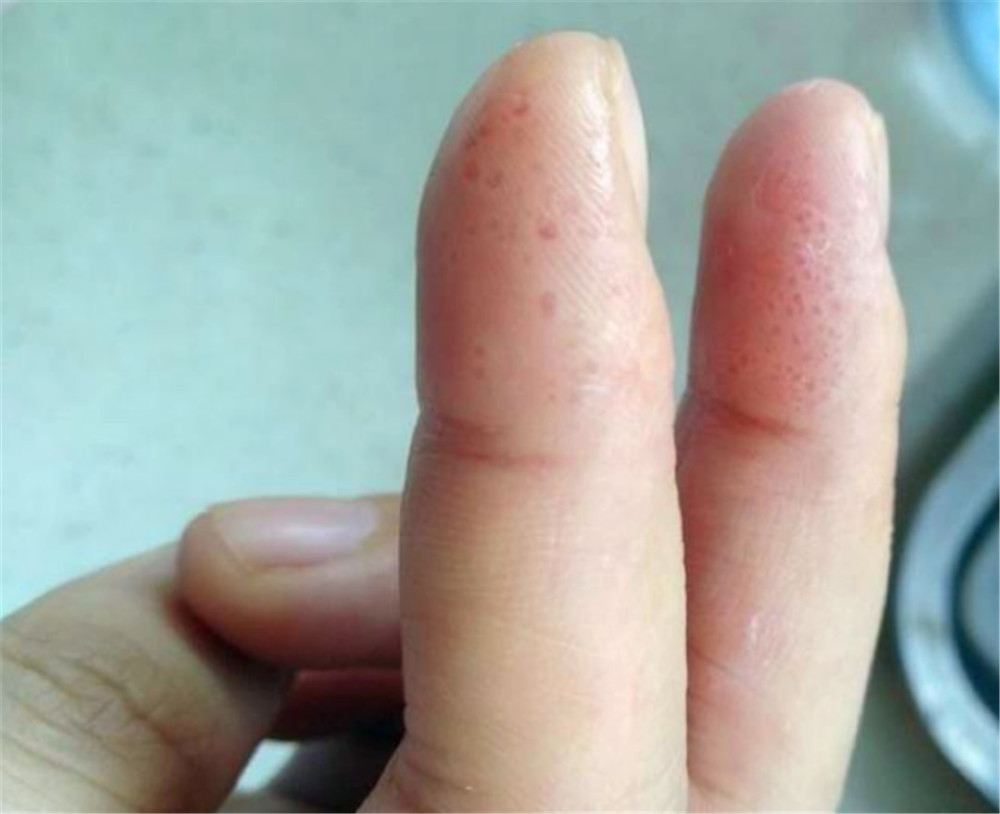 手指上长透明小水泡,有时会痒,弄破后有液体溢出,该怎么治疗?